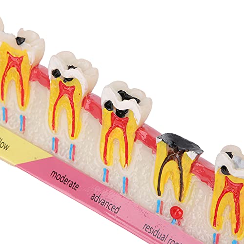 Diş Çürüğü Modeli, Diş Hastalığı Modeli Diş Öğretim Çalışması için Gözlemlenmesi kolay